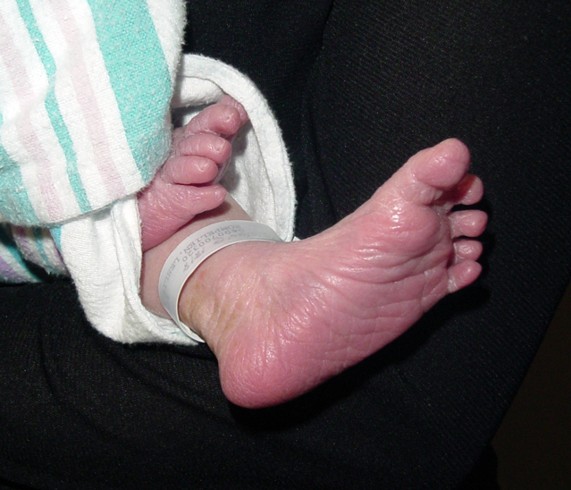 Отсроченное пережатие пуповины снижает неонатальную смертность у недоношенных детей