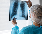 Рак легких составляет до трех четвертей от всех случаев профессиональных злокачественных опухолей