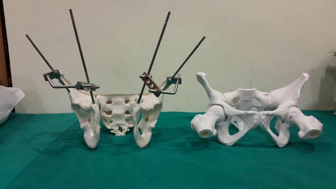 В России впервые установили 3D-имплантат кости онкопациенту