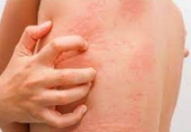 Атопический дерматит вызывает воспалительные заболевания кишечника