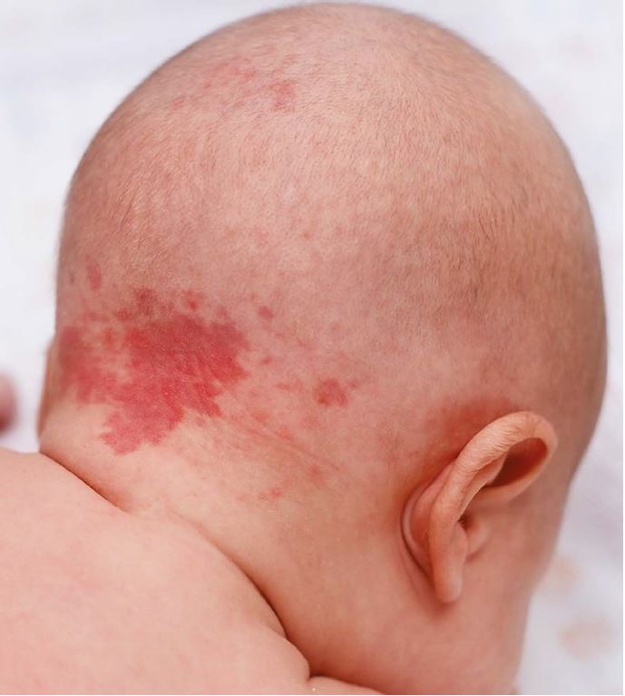 Клинические маски и диагностические ловушки редкой патологии