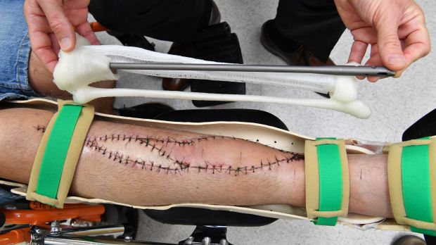 Пациенту имплантировали напечатанную на 3D-принтере кость голени