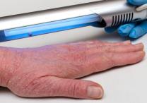 Фототерапия помогает в лечении атопического дерматита