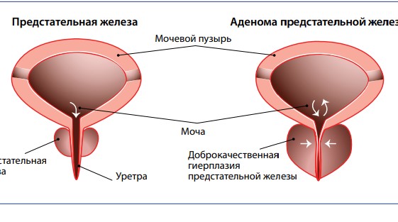 IPSS как источник объективной информации о пациенте с доброкачественной гиперплазией предстательной железы