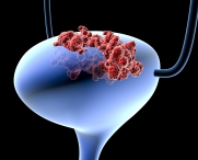 Почему мужчины чаще болеют раком мочевого пузыря?