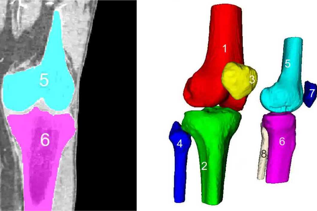 Травмы коленного сустава помогут лечить компьютерные алгоритмы