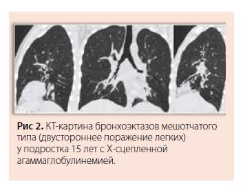 Рис 2. КТ-картина бронхоэктазов мешотчатоготипа (двустороннее поражение легких)у подростка 15 лет с Х-сцепленнойагаммаглобулинемией.