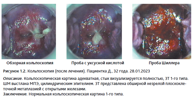 Эрозия и эктопия (ВПЧ-инфекция). — Гинекологический кабинет О.В. Кичигина — Сигма-Мед Калининград.