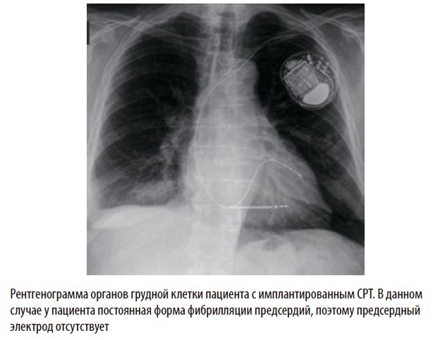 Рентгенограмма органов грудной клетки пациента с имплантированным СРТ. В данномслучае у пациента постоянная форма фибрилляции предсердий, поэтому предсердныйэлектрод отсутствует